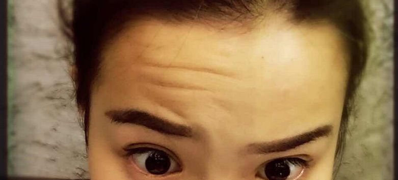 超聲波去眼袋：效果持久還是短暫？