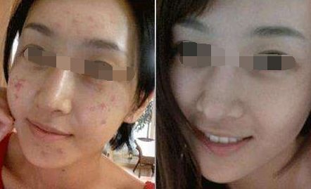 腿部吸脂術(shù)后出現(xiàn)腳腫現(xiàn)象，如何緩解？