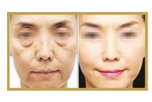 酒窩的定義及相關(guān)風(fēng)險(xiǎn)，你知道嗎？