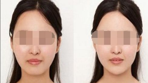 雙眼皮修復的方法有哪些？解析雙眼皮修復技術簡介