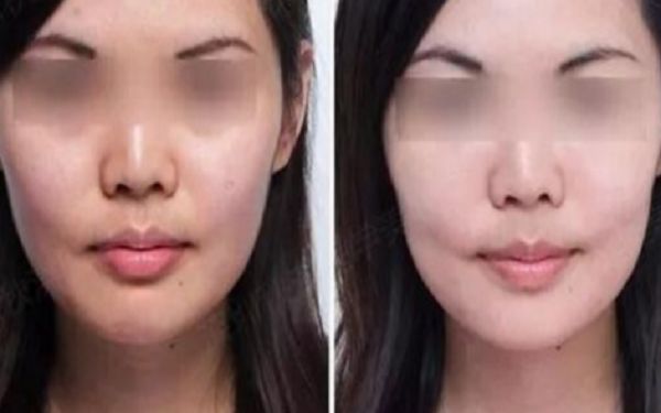 35歲采用超聲療程好還是熱瑪吉更好？匿名評測揭秘！