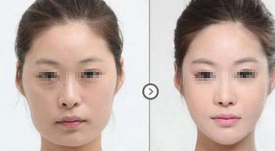 皮膚松弛，如何選擇適合的醫(yī)美項目？熱門方式如熱瑪吉、拉皮等對比解析！