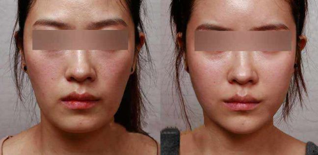 眼袋手術(shù)后效果持續(xù)多久？解析專家分享