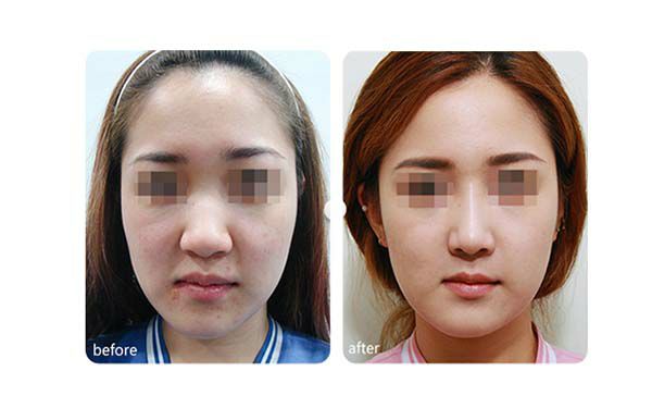 下頜角重塑：手術前后需要注意的事項