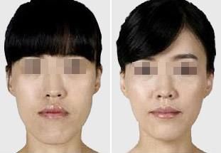 肋骨隆鼻后的面部消腫需要多長(zhǎng)時(shí)間？消腫小竅門曝光！