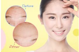 開內(nèi)眼角手術(shù)的疼痛程度如何？解析內(nèi)眼角手術(shù)的全貌