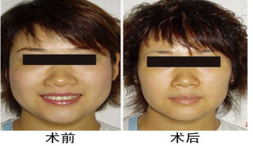 咬肌切除手術(shù)后對(duì)面部功能是否會(huì)受影響？