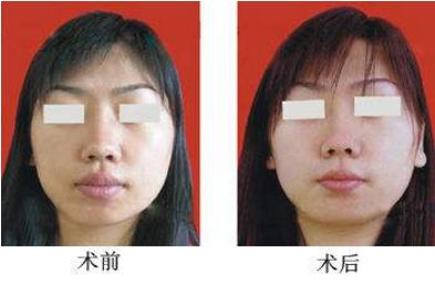 隆鼻手術(shù)費用及失敗原因，臨床體征全解析