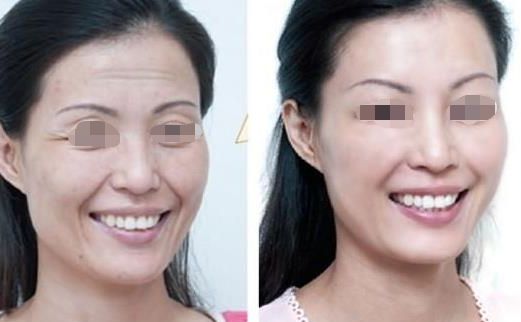 面部吸脂瘦臉效果如何？達(dá)到自然效果的關(guān)鍵是什么