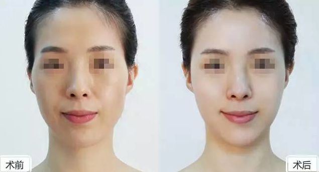 假體隆胸保持持久效果有多久？假體隆胸2個(gè)月后是否固定？