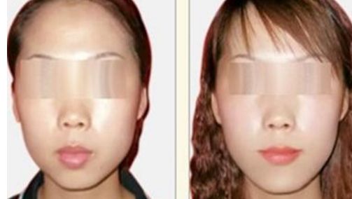 打造明亮迷人雙眼，領(lǐng)略三點(diǎn)雙眼皮手術(shù)的魅力