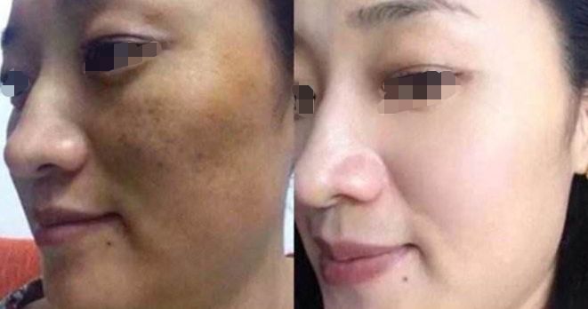 淚溝填充：熊貓針VS膠原蛋白，手術(shù)過程與注意事項(xiàng)解析