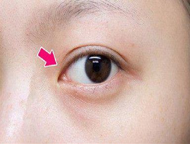 吸脂隆胸手術(shù)費(fèi)用及效果維持時間解析