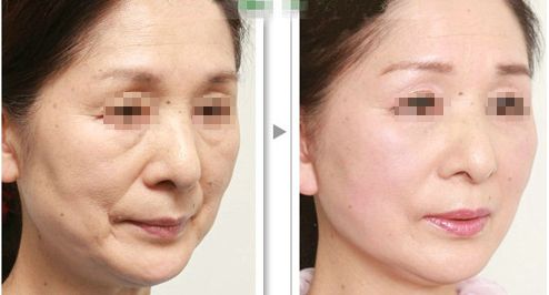 解脂能祛眼袋嗎？多少錢？功效與注意事項(xiàng)詳解