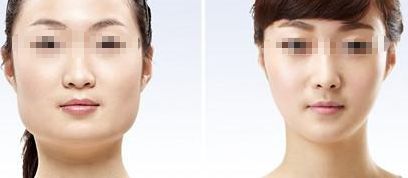有效去除咬肌的兩種方法，輕松擁有優(yōu)美小臉