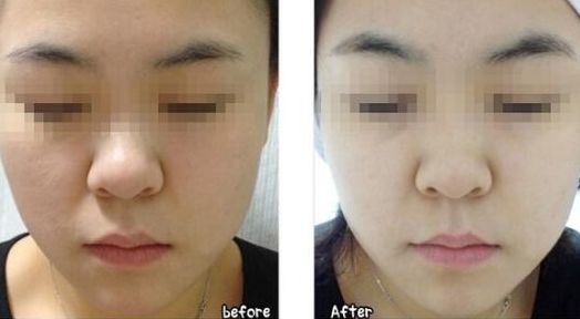韓式微創(chuàng)無痕處女膜修復(fù)的效果如何？