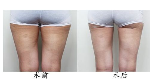 體驗光子嫩膚，解密北京光子嫩膚價格