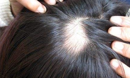 南京新生醫(yī)院植發(fā)效果如何？坐診專家簡介、詳細地址一覽