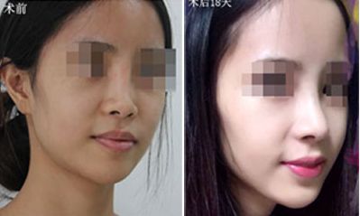 深圳哪家醫(yī)院隆胸效果好？排名前五火熱推薦！