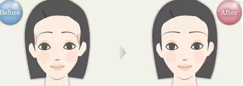 浙江哪家醫(yī)院眼袋祛除效果好？
