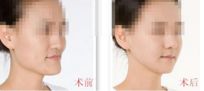 廣東省人民醫(yī)院美容科專家團隊與隆鼻手術揭秘 廣東省人民醫(yī)院美容科專家團隊與隆鼻手術揭秘