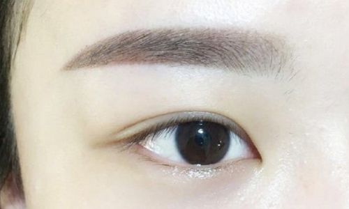 北京郭建玲雙眼皮手術(shù)費(fèi)用是否昂貴？醫(yī)生案例分享全面解析