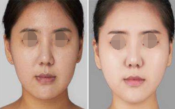 西安整形醫(yī)院的磨骨技術(shù)有哪些優(yōu)點？