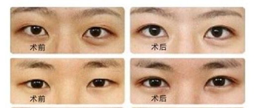 菲塑美減肥針：效果評(píng)估、價(jià)格和潛在風(fēng)險(xiǎn)全解析