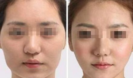 揭秘北京東方和諧脂肪填充真容，真實案例展示精湛技藝！