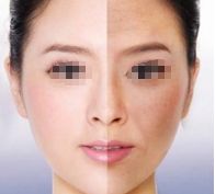 劉志剛醫(yī)生雙眼皮手術(shù)效果怎么樣？