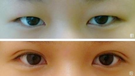 上海九院雙眼皮手術效果怎么樣？錢云良醫(yī)師的全新案例分享