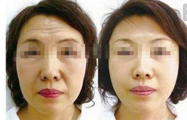 四川人民醫(yī)院王佳醫(yī)生提供下頜角整形案例，讓你輕松擁有小V臉