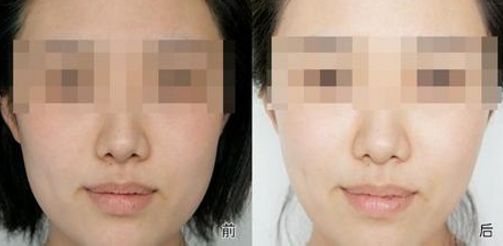 【揭秘】成都雙眼皮醫(yī)院最佳選擇，眼部微創(chuàng)手術秘訣大公開！