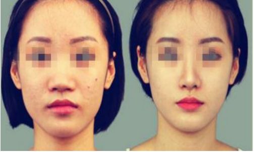 贛州哪家醫(yī)院的鼻部整形好？