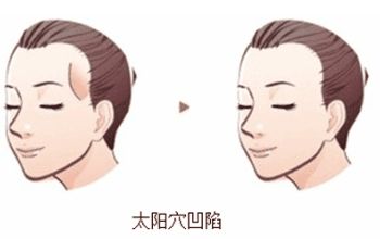 蘇州美貝爾與美萊：隆鼻比較！價(jià)格與特色對(duì)比！
