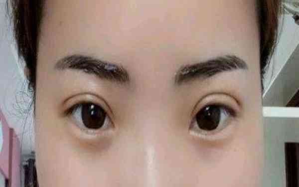 丁硯江填充脂肪的效果如何？為什么該方法備受推崇？