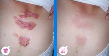九院脂肪填充，醫(yī)生技術高超，詳細價格表揭曉