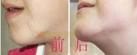 長(zhǎng)沙最佳吸脂手術(shù)醫(yī)院排名，雅美、華韓華美、鵬愛(ài)等值得借鑒的評(píng)價(jià)
