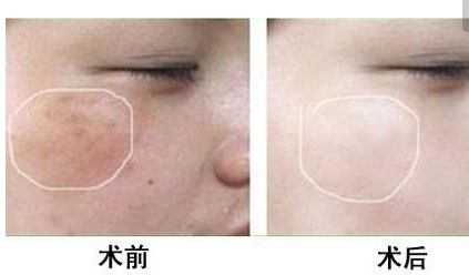 長沙美田芳斌雙眼皮讓你驚艷！令人難忘的改變來襲！