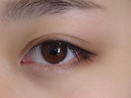 杭州任東做鼻部整容效果如何？MD技術(shù)解析真實案例分享！