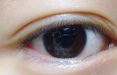 健麗整形醫(yī)院的去眼袋效果如何？2023患者分享案例！