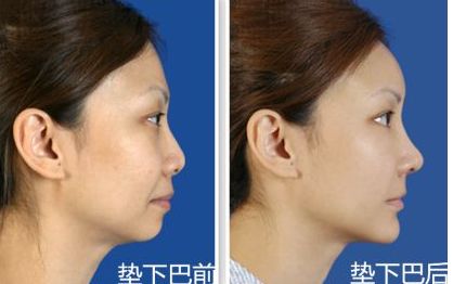 上海九院鼻部整形手術專家李圣利，專業(yè)水準如何？