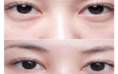 北京張笑天的下頜角手術(shù)技術(shù)及豐碩成果曝光！醫(yī)術(shù)精湛，案例展示震撼人心