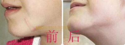 上海哪家醫(yī)院有專業(yè)的唇裂手術(shù)醫(yī)生？治療兔唇患者的必備信息！