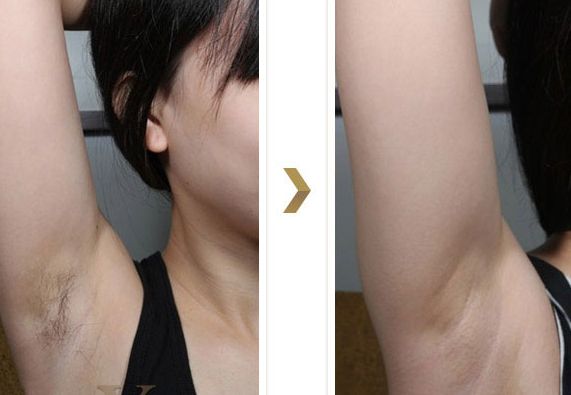 長(zhǎng)沙湘雅醫(yī)院的減肥科如何？大腿吸脂效果如何？