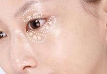 杭州葉秀娣做雙眼皮具體效果如何？專家實(shí)踐案例發(fā)布