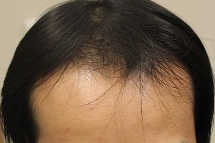 哪家常州效果比較好的祛疤醫(yī)院？常州波射保逸效果如何？