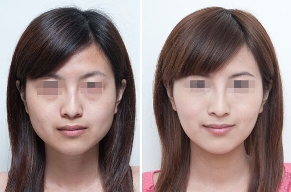 鄭州假體隆胸：哪家醫(yī)院在同類榜單有亮眼表現(xiàn)？