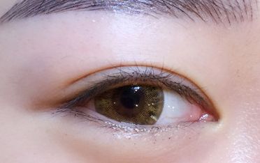 鄒翀，這一雙眼皮技術，近期有所革新
