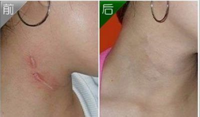 廣州隆胸手術(shù)費(fèi)用及案例分享，口碑如何？